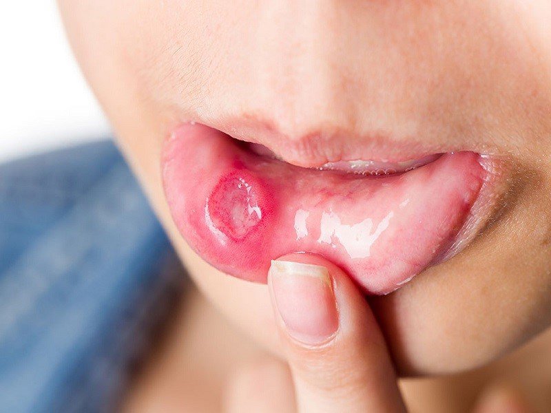 Bệnh tay chân miệng gây ra các vết lở loét trong khoang miệng